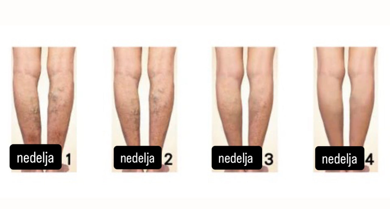Veins Spray – Tajna Laganih i Zdravih Nogu! 1+1 Gratis